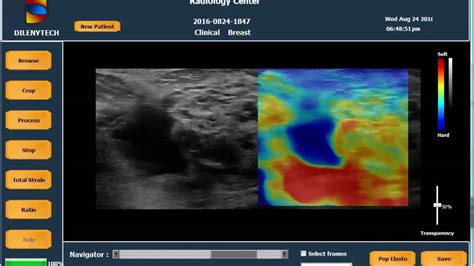 Ultrasound Elastography Using Us Elasto V Women Breast Clinical