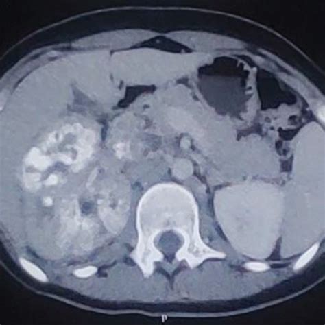 Axial CT scan showing right renal calcifications with involvement of ...