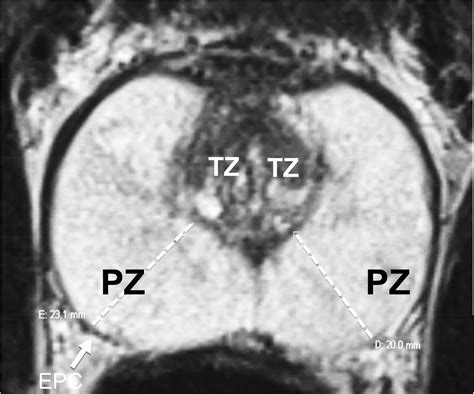 Prostate Gland Anatomy Mri