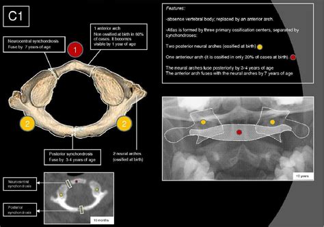 Figure 1 From Radiographic Atlas Of Pediatric Cervical Spine In