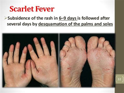 Streptococcal Infections As Related To Apnea Of Prematurity Pictures