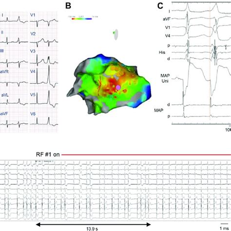 A Twelve Lead Electrocardiogram Showing Sinus Rhythm And Subsequent