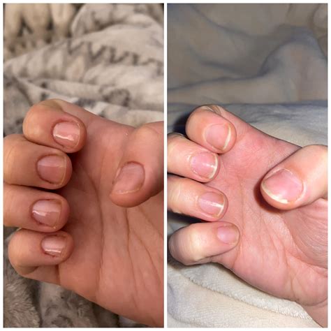 This Is A Week Of Nail Growth 1 Week Bite Free So Happy To See Some