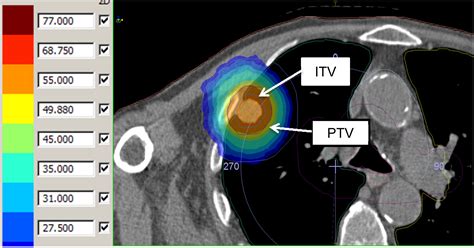 Stereotactic Ablative Body Radiotherapy For Lung Cancer Clinical Oncology