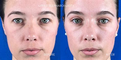 5 Of The Best Eyelid Rejuvenation Options And Their Results Dr Nerina