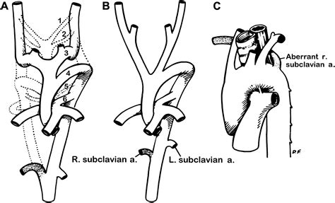 Contemporary Management Of Aberrant Right Subclavian Arteries Annals Of Vascular Surgery