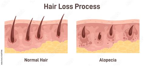 Alopecia Hair Loss Balding Process Cross Section Anatomical