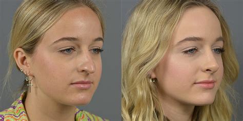 Nose Surgery Before After Patient Dr Marotta