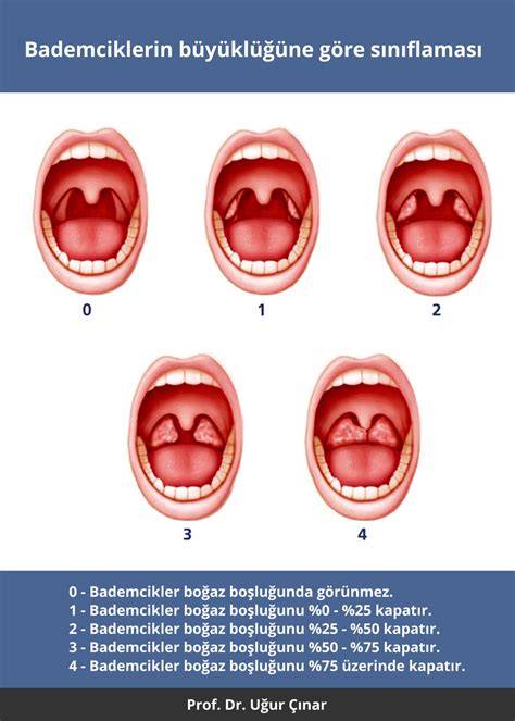 Bademcik Enfeksiyonlar Nas L Tedavi Edilir Prof Dr U Ur Nar