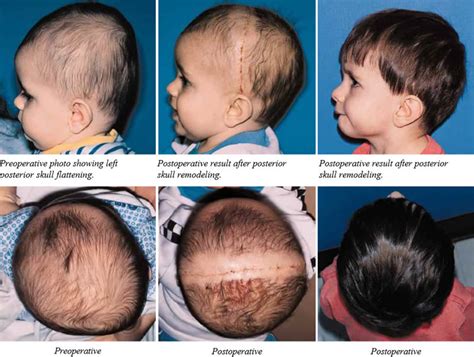 Posterior Plagiocephaly