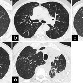 Radiological Manifestations Of IgG4 Related Lung Disease On Chest