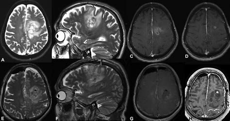 Preoperative And Immediate Postoperative MRI Images Of Case 3 Are