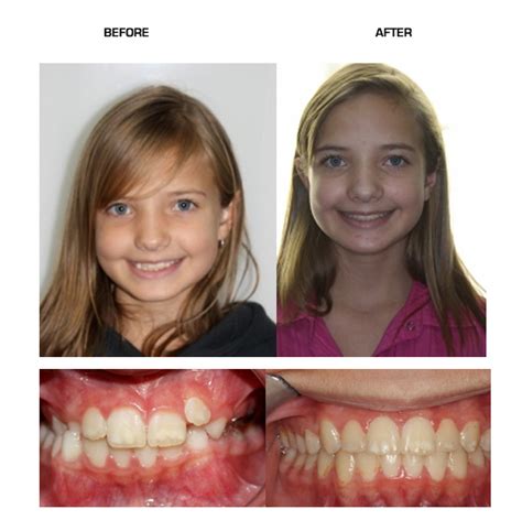 Palate Expander Before And After