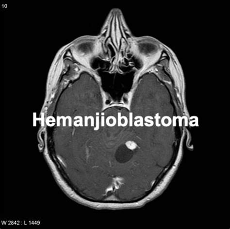 Hemangioblastoma