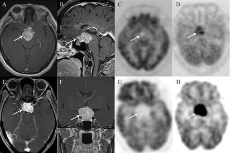 Differentiation Of Suprasellar Meningiomas From Non Functioning