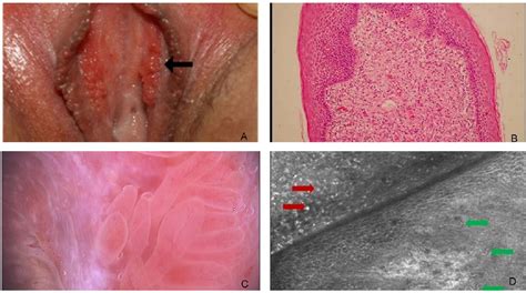 Figure 1 From Vestibular Papillomatosis An Important Differential