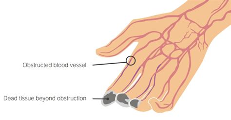 Thromboangiitis Obliterans (Buerger’s Disease) | Concise Medical Knowledge