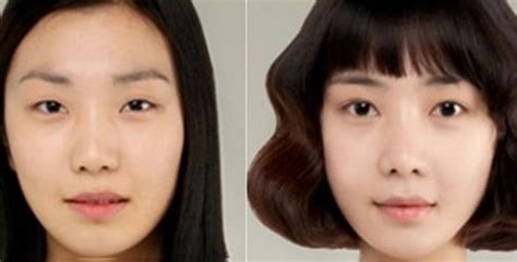 6 Before and After Korean Plastic Surgery Dramatic Shots - Seoul TouchUp | Korean Plastic ...