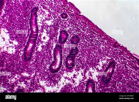 Endometrial Hyperplasia Light Micrograph Of A Section Through Tissue