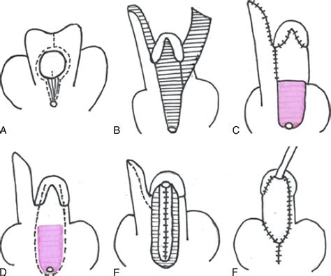 Two Stage Repair For Severe Proximal Hypospadias Using Oral Annals