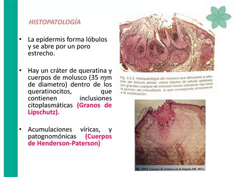 Molusco Contagioso Herpes Virus Y Queratolisis Plantar Dermatología