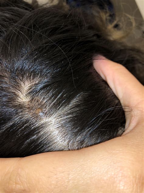 Painless lump on scalp? I’ve had this lump on my head for a few years now and it just hasn’t ...