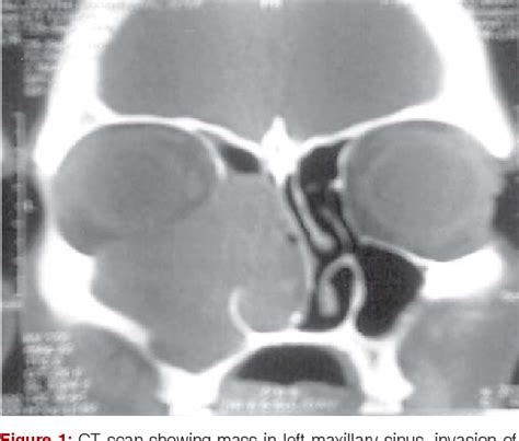 Figure From Bony Hemangioma Of Maxillary Sinus A Rare Presentation