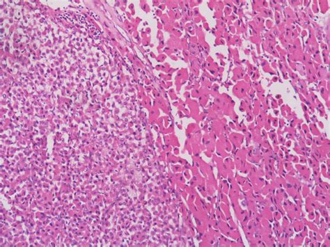 Adrenal cortical carcinoma – Histopathology.guru