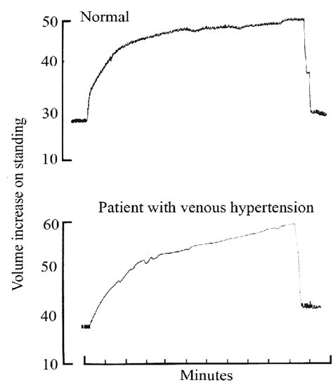 31 Two Curves Obtained With Strain Gauge Plethysmography One In A