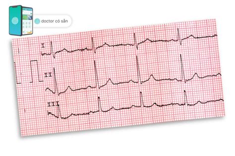 Điện tim là gì Đo điện tim điện tâm đồ để làm gì Doctor có sẵn