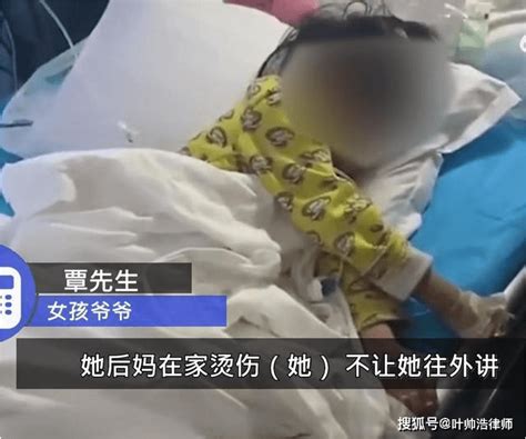 4岁女孩被后妈打得遍体鳞伤，双脚烫伤严重需截肢，随时可能猝死女童遭虐待双脚烧伤 生父继母被刑拘监护权被害人