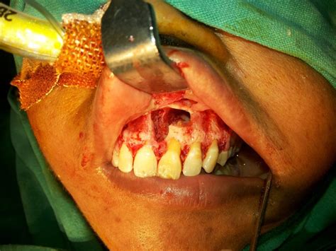 Oral Maxillofacial Surgery Dr Ahuja S Dental Implant Clinic