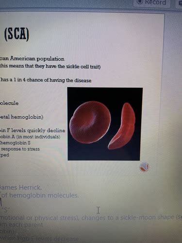 Exam Sickle Cell Anemia Flashcards Quizlet