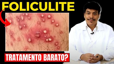 Qual O Melhor Tratamento Caseiro Para Foliculite Revelado Youtube