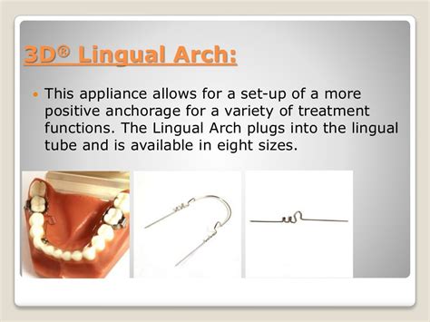 Lingual Arch Space Maintainer