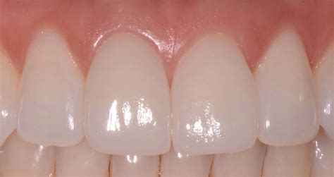 Dental Veneers Same Day Treatment In Sunnyvale