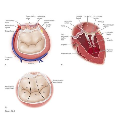 Minimally Invasive Mitral Valve Repair Artofit