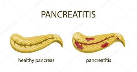 Pancreas Healthy And Pancreatitis — Stock Vector © Artemida Psy 81080844