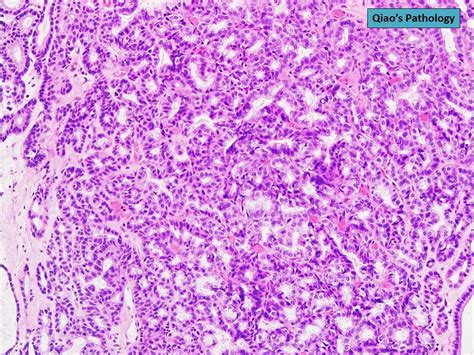 Flickriver Photoset Intracholecystic Papillary Tubular Neoplasms