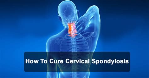 How To Cure Cervical Spondylosis Causes Symptoms And Treatments