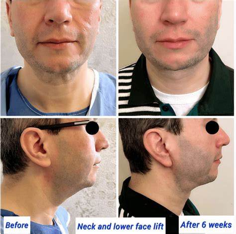 Facelift And Neck Lift Everything You Need To Know Harley Clinic