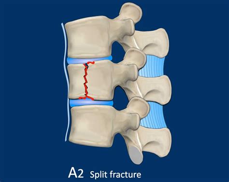 The Radiology Assistant Ao Spine Classification Of Thoracolumbar