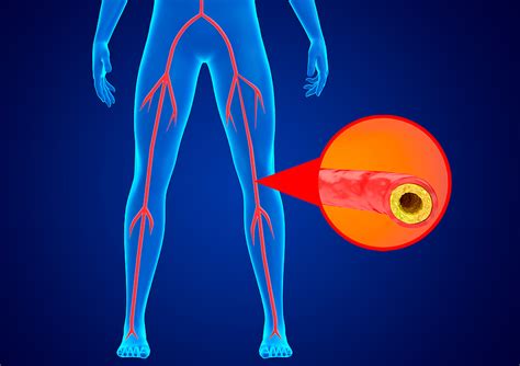 Peripheral Artery Disease American Heart Center Pc