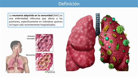 Neumonía Adquirida En La Comunidad En Adultos Según La Gpc Mexicana