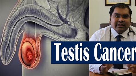 Testis Cancer Patient Information Hindi अंडकोष की गांठ कैंसर हो