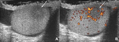 Benign And Malignant Intratesticular Lesions Sonographic Features