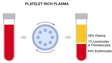 Platelet Rich Fibrin Prf Vedas Med Spa And Wellness Center