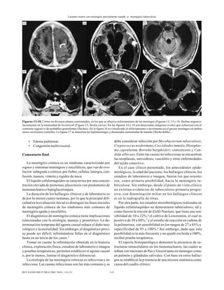 Lactante Menor Con Meningitis Parcialmente Tratada Vs Meningitis