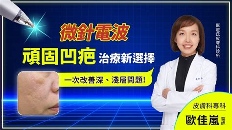 頑固深凹痘疤新選擇「微針電波」痘疤、毛孔、膚質一次改善｜幫痘氏公館皮膚科 Youtube