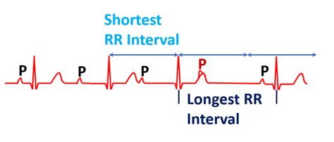 Features Of Wenckebach Phenomenon All About Cardiovascular System And Disorders